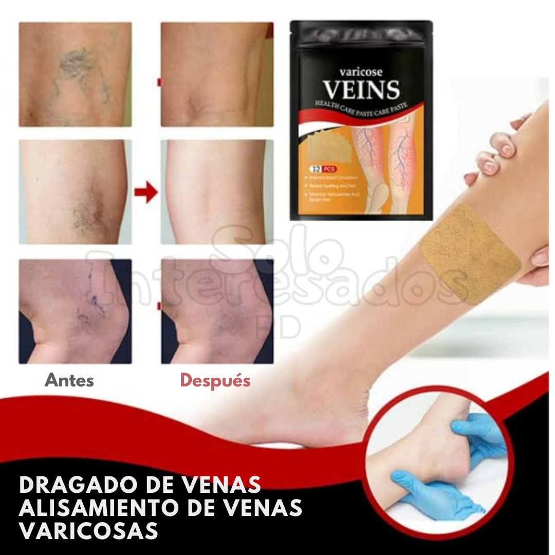 AdiósVárices