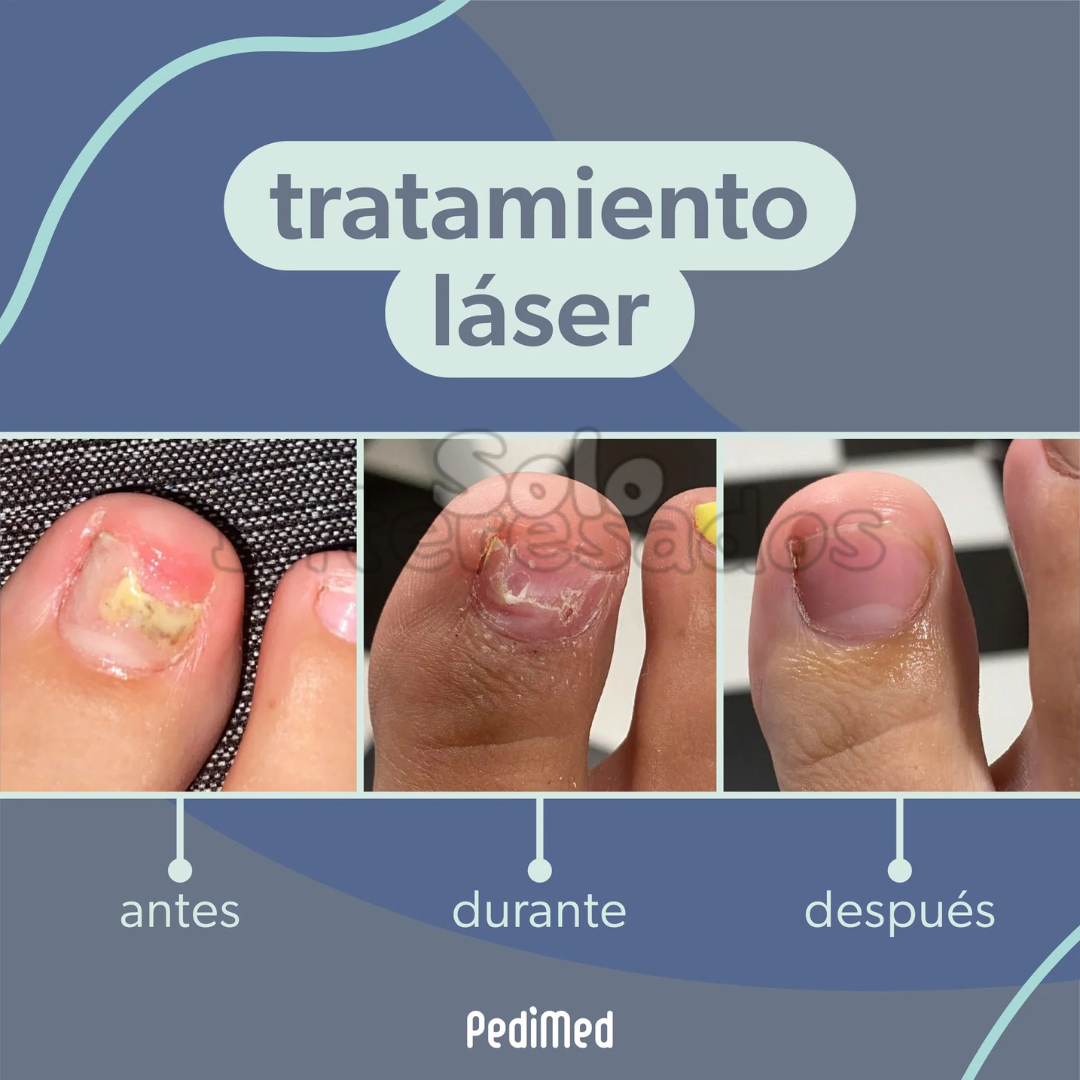 Adiós Hongos Laser