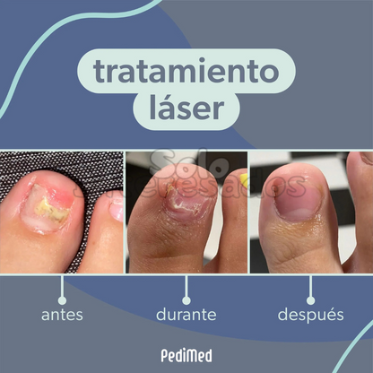 Adiós Hongos Laser